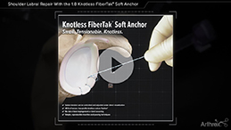 1.8 Knotless FiberTak<sup>®</sup> Soft Anchor